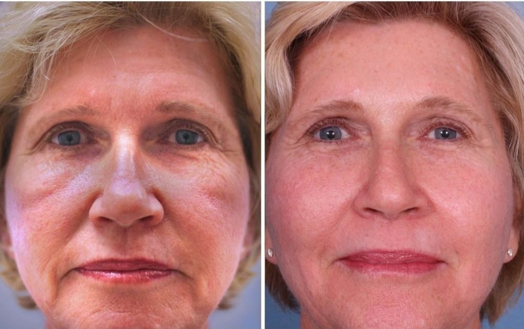Las Máscaras LED Facial antes y después